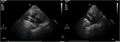 Case Report: Successful Reperfusion of Pulmonary Thromboembolism Using tPA in a Cat